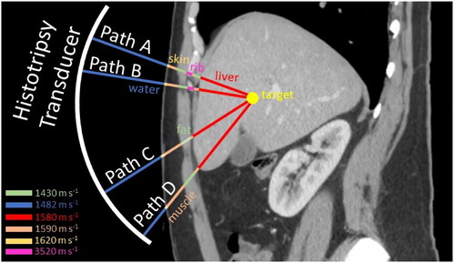 Figure 1. Heterogeneous tissue paths. Ultrasound waves from different portions of the histotripsy transducer aperture take heterogeneous paths to the target due to differences in the speed of sound among water and different tissues.