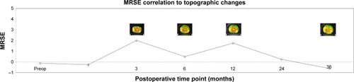 Figure 6 Longitudinal corneal topographic changes associated with MRSE changes in a single patient. Pronounced correlation of topographic “ring” disappearance and myopic regression in late postoperative interval.