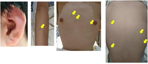 Figure 2. Skin rashes with crusting (ear lobe, arm, chest, and back).