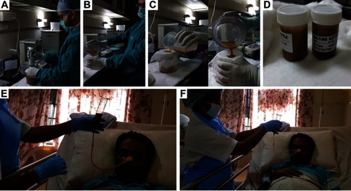 Figure 5 Procedure for nasoduodenal fecal microbiota transplantation in alcoholic hepatitis. Before the procedure, a prokinetic is administered. (A) Blending of freshly collected (30 g) of stool sample with normal saline for 2 mins. (B) Filteration of the stool suspension to remove solid vegetable matter followed by (C) repeat filtration through sterile gauze to homogenize the suspension. (D): filtered stool suspension packed into sterile containers. (E) Infusion of stool suspension through a nasoduodenal tube in a patient with alcoholic hepatitis in grade 2 hepatic encephalopathy. (F) Post infusion, 50 mL normal saline flush is performed.