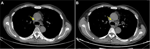 Figure 2 CT images of case 1 in September (A) and November (B). The enlarged mediastinal lymph node (arrow) decreased after antituberculosis therapy.