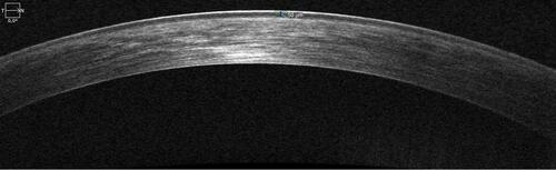 Figure 1 HD-OCT showing the hyperreflective epithelium boundaries, corresponding to tear film and anterior surface of Bowman layer, respectively.