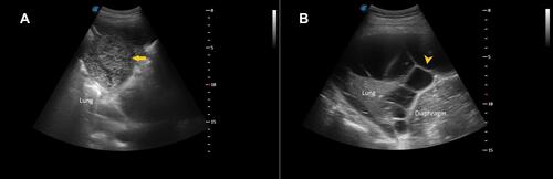 Figure 3 (A) Ultrasound showing left-side lung consolidation and heavily echogenic effusion (arrow) which turned out to be pus on thoracentesis. (B) Ultrasound showing multiple septations (arrowhead) in the pleural collection with underlying lung consolidation just above the left hemidiaphragm.