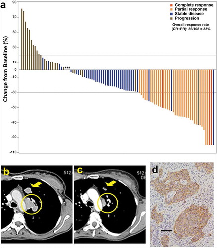 Figure 3. (a) Waterfall plot illustrating the best response data in 108 triple-negative breast cancer patients treated with sacituzumab govitecan (adapted from Bardia et al.,Citation50 with permission). (b–d) Tumor shrinkage by CT in triple-negative breast cancer patient given sacituzumab govitecan (from Bardia et al.Citation38 with permission). Case study: A 48-year-old woman with an initial diagnosis of triple-negative breast cancer in received four prior lines of treatment (including an anti-PD-L1 immune checkpoint inhibitor) and presented with lung and lymph node metastases at enrollment. She achieved a partial response that started 1.7 months after initiation of treatment with sacituzumab govitecan, with the best response of 54% reduction at 9.0 months and progression occurring at 14.4 months (partial response duration, 12.7 months). (b) Baseline image of two of the three target lesions: a 24 x 19-mm left-upper-lung mass (arrow) and a mediastinal lymph node (17 x 29-mm; circle). (c) After 16 doses, these two target lesions decreased to 13 × 7 and 9 × 19 mm, respectively. (d) TROP-2 expression in an archived tumor specimen by immunohistochemistry that shows 1+ to 2+ staining (overall, 2+).