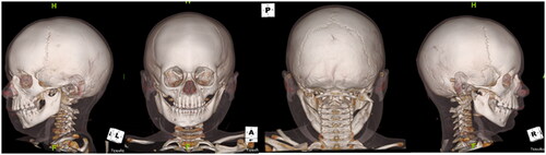 Figure 1. CT craniomaxillofacial findings revealed a complex, tripartite mandibular fracture, including bilateral condylar fractures with lateral dislocation of the left condyle and a symphyseal fracture. Specifically, there was a comminuted left condylar fracture with medial and inferior displacement of the fracture fragments as well as lateral and inferior dislocation of the intact lateral aspect of the condyle; near complete right subcondylar fracture with lateral apex angulation as well as medial and inferior dislocation of the right mandibular condyle; a mildly distracted oblique left parasymphyseal fracture; retrognathism; and, associated perimandibular soft tissue edema with mild subcutaneous edema on the right, and a 1.0 cm hematoma adjacent to the left mandibular condyle.