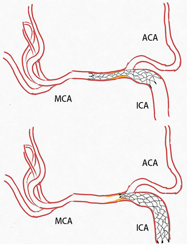 Figure 4 Schematic figure shows the delayed displacement of the stent.