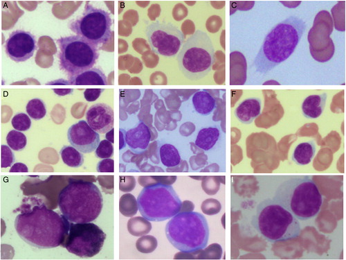 Figure 2. The morphological features of lymphoid cells in peripheral blood and/ or bone marrow aspirate (100x; May Grunwald Giemsa stain) (A) Hairy cells of HCL. (B) SMZL showing monocytoid lymphocytes. Short polar villi seen in one of them (C) Villous lymphocyte of SMZL (D) CLL showing small lymphocytes along with occasional prolymphocytes (E) B-cell PLL showing predominantly prolymphocytes (F) MCL showing lymphoid cells with irregular cleaved nucleus (G) Intravascular large B cell lymphoma showing blastoid appearing lymphoid cells (H) γδ HSTL showing medium to large sized lymphoid cells (I) CLPD NK cells showing large granular lymphocytes.