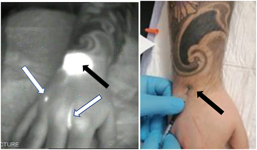 Figure 5 Abnormality type 4. The NIRFI (left sided) shows abnormal back flow from the injected site (black arrows) at the level of wrist under the tattooed area (subject p2a) toward the 2nd and 4th inter-digital spaces (white arrows).