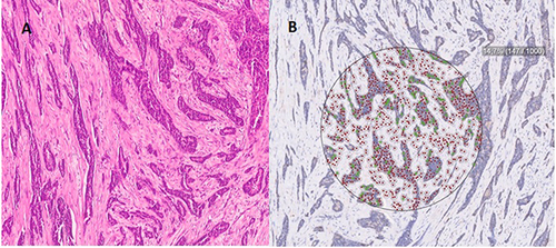 Figure 2 Invasive breast carcinoma according to MCM-2 levels according to TAILORx risk categorization (ODX-RS: 9 and MCM-2 level: 14%).