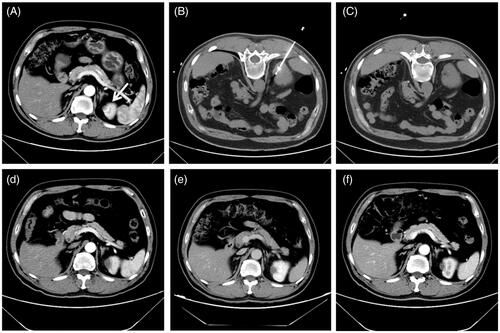 Figure 1. A 1.4 cm tumor lesion in a solitary kidney of a 54-year-old man treated with microwave ablation. (A) Preablation axial contrast-enhanced CT image shows one heterogeneous hyperdensity neoplasm (white arrow) in left kidney. (B) Axial unenhanced CT scan obtained after placement of microwave antenna with CT guidance. (C) Axial unenhanced CT scan after withdrawn of microwave antenna shows the low-density ablation zone. (D, E, F) axial contrast- enhanced CT images show no enhancement in the ablation zone for 1-, 3-, and 12-month after ablation, respectively.