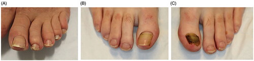 Figure 4. Clinical presentations of Beau’s lines, onychomadesis and retronychia. (A) Beau’s lines on the left toenails. (B) Onychomadesis of the left great toenail. (C) Retronychia of the right great toenail [Citation20].