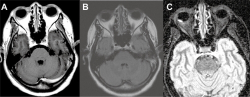 Figure 7 Case 2. Brain magnetic resonance imaging in FLAIR (fluid-attenuated inversion recovery sequence) (A), T1 weighted with gadolinium (B) and STIR (short-tau inversion recovery sequence) (C). The nodular lesion appears in well limited hypersignal in the right eye, with no gadolinium enhancement. The hypersignal is most prominent in the STIR sequence.