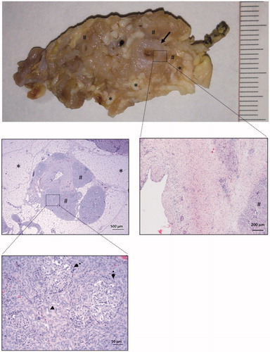 Figure 4. Common histological features of complete atrophy. The main pancreatic duct (arrow) is dilated and provided with a thick fibrotic wall. The acinar component of the pancreatic tissue has completely disappeared (atrophy score 5) and is replaced by lobules (#) of pseudo-ductal complexes with some dilated ducts (arrowheads). In these lobules, islets of Langerhans were easily seen (broken arrows). In between these lobules, there was marked interlobular adipose infiltration (asterisk).