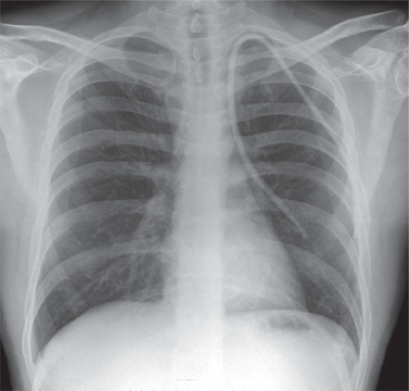 Figure 1 Chest X-ray depicting abnormal position left internal jugular catheter.