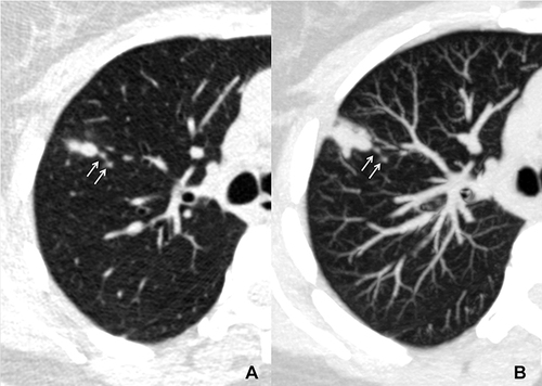 Figure 4 A patient with pulmonary cryptococcosis. (A) axial and (B) maximum intensity projection images show a solid nodule located in the right upper lobe. There are multiple scattered smaller nodules (satellite lesions, arrows) in the adjacent lung field.