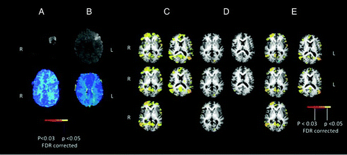 Figure 10. Panel A: DWI (top) and PWI (bottom) at Day 1 for Participant 4. Panel B: DWI (top) and PWI (bottom) at Day 1 for Participant 5. Panel C: Functional magnetic resonance imaging (fMRI) activation associated with the orthographic task (retrieval of spelling) for Participant 4. Panel D: fMRI activation associated with the orthographic task (retrieval of spelling) for Participant 5. Panel E: Activation for Participant 4 minus activation for Participant 5, associated with the orthographic task. fMRI activation maps are false discovery rate (FDR) corrected for multiple comparisons and are displayed with a threshold of p < .05. Volumes with greater than 2 mm movement were censored out. [To view this figure in colour, please see the online version of this journal.]