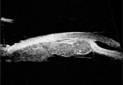 FIGURE 2  Ultrasound Biomicroscopy image shows a bilobed moderately echogenic solid lesion, arising from the undersurface of the iris and involves the pars plicata. There were 2 hyperechogenic dots within one lobe (Arrow). Iris appears thinned out over the mass.