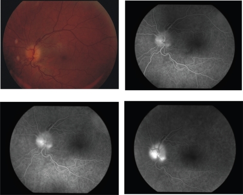 Figure 2 Case 3 on presentation. Color fundus photo and fluorecein angiograms.