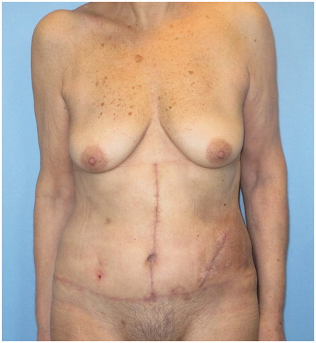 Figure 5. One-month postoperative result.