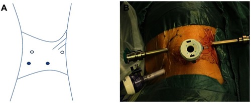 Figure 1 Port placement for retroperitoneal robot-assisted laparoscopic upper pole heminephrectomy. (A) Trocar locations. Two 12-mm ports were placed and used as a camera port and an assistant port. Two 8-mm ports were placed for the remaining robotic arms. Open circles represent 8-mm ports, and closed circles 12-mm ports. (B) Patient positioning for left dissection.