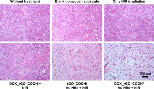 Figure 6 Images of H&E-stained tumor sections collected from the mice bearing tumors after various treatments including DOX_rGO–COOH + NIR radiation, rGO– COOH/Au NRs + NIR radiation, and DOX_rGO–COOH/Au NRs + NIR radiation. The tumors were also collected from the two control groups and the group only receiving NIR radiation.Abbreviations: Au NRs, gold nanorods; DOX, doxorubicin; rGO–COOH, carboxylated-reduced graphene oxide; NIR, near infrared.
