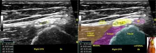 Figure 6 (A) Illustrates a swollen common fibular nerve (CFN) at fibular head of Figure 4 with a swollen nerve fascicle with a cross-sectional area of 3 mm2. The color shading in (B) with labeling are for illustration purpose. Image is courtesy of 3D4Medical’s Essential Anatomy 5 appAbbreviations: BF, biceps femoris; Gastroc, gastrocnemius; LSCN, lateral sural cutaneous nerve.