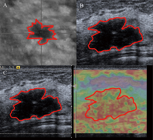 Figure 1 Outline of the ROI for the three examinations. (A) ABVS image. (B) B-ultrasound image. (C) SE image (In the SE image, we depict the ROI based on the B-ultrasound image on the left of the image, then copy it to the SE image on the right.).