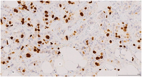 Figure 1. Nuclear Ki67 immunohistochemical staining demonstrating variation in staining intensity.