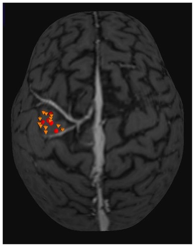 Figure 2 Three-dimensional MRI used in neuronavigation system. Yellow octahedrons are points with motor response recorded in the TMS mapping. Red circles are the points with the motor response in DES mapping.