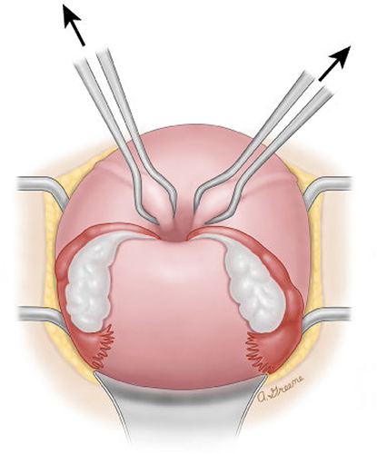 Figure 2 In the Huntington procedure, the cup formed by the inversion is located. A clamp, such as an Allis or Babcock clamp, is placed on each round ligament entering the cup, approximately 2 cm deep in the cup. Gently pulling on the clamps exerts upward traction on the inverted fundus. Clamping and traction are repeated until the inversion is corrected. The myometrium can be clamped if the round ligaments cannot be identified.