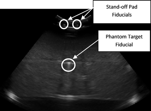 Figure 6. Sample ultrasound image showing one phantom fiducial and two stand-off pad fiducials.