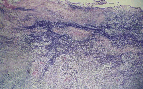 FIGURE 3  Histopathological examination of the specimen showing multiple granulomas in the sclera. Hematoxylin and eosin, ×100.