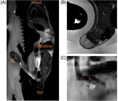 Figure 3. (A) Sagittal T2‐weighted full body image acquired to plan the therapy. (B) Detailed transversal T2‐weighted image at tumour location acquired with the sequence used for immediate evaluation of the treatment effects. (C) Magnitude image of the temperature mapping sequence in a scan plane perpendicular to the HIFU beam at the tumour location. T, tumour; L, leg; F, foot.