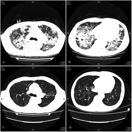 Figure 3. Chest CT of patient no. 5: (A and B) chest CT scans showing the presence of symmetrically distributed infiltrations and (C and D) follow-up chest CT scan after 3-week treatment showing the marked radiological improvement of the same infiltrations.