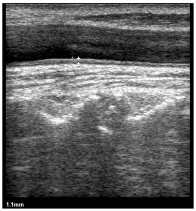 Figure 1 Longitudinal sonogram shows that the CIMT is 1.1 mm in a patient with NAFLD.