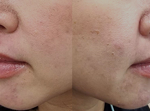 Figure 5 Post-inflammatory hyperpigmentation with comedones and some inflamed papules on both cheeks and chin. (Case 3).