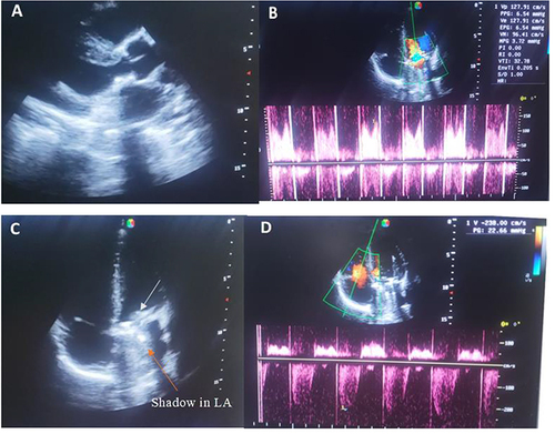 Figure 2 Transthoracic echocardiography showing a well seated mitral metallic valve (A) and normal trans mitral prosthetic valve mean pressure gradient of 3.7 mmHg (B), Apical 4-chamber view showing a metallic prosthetic valve at the mitral valve area (C) (white arrow) and mechanical valve shadow in the left atrium (LA) (orange arrow) with normal velocity and pressure gradient across the tricuspid valve (D).