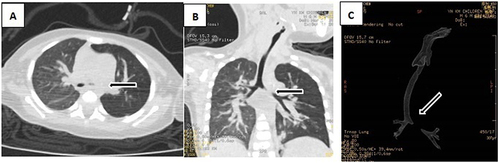 Figure 5 6-month-old child presented with cough and wheezing for 7 days. On auscultation, the breath sounds in the left lung were significantly reduced. Chest CT scan with airway reconstruction showed increased translucency of the left lung, with multiple patchy high-density shadows bilaterally. On bronchoscopy, a small amount of sputum was seen in the left main bronchus with the left main bronchus softened and collapsed causing obstruction.