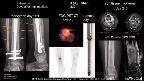 Figure 2. Osteolysis and periosteal reaction at postoperative day 229 (48 days after the onset of symptoms, i.e., pain in the area). FDG PET CT revealed increased glucose uptake in the area. The removed nail (day 239) had discoloration (potential corrosion) and on MRI on the subsequent day cortical destruction and periosteal reaction of the right tibia as well as soft tissue involvement were present. In comparison, a Stryde nail without discoloration was simultaneously removed from the asymptomatic left side.