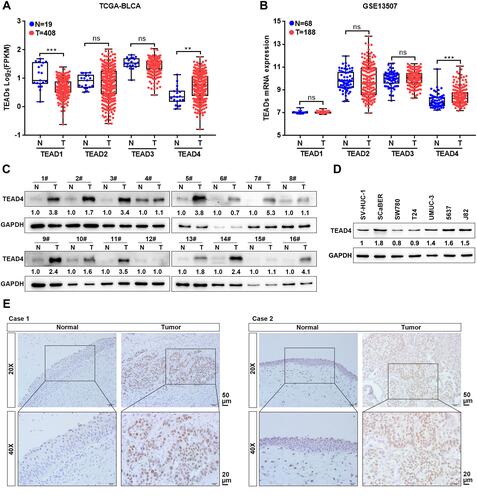 Figure 1 TEAD4 is highly upregulated in UBC. (A and B) TEAD1–4 mRNA expression levels between UBC tissues (T) and their adjacent noncancerous tissues (N) in TCGA-BLCA (A) and GSE13507 (B) datasets. (C) TEAD4 protein levels in 16 paired UBC tissues (T) and their adjacent noncancerous tissues (N) were examined by Western blotting. (D) Endogenous expression of TEAD4 in SV-HUC-1 and multiple UBC cell lines were detected by Western blotting. (E) Representative IHC staining images of the localization and expression of TEAD4 in normal urothelium epithelial and UBC tissues were displayed. Scale bar, 50 and 20μm. **P<0.01, ***P<0.001.