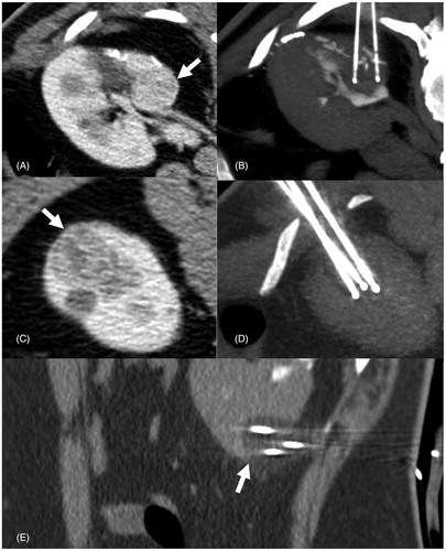 Figure 4. Percutaneous cryoablation of renal clear cell tumor of the right kidney. (A) Arterial phase contrast-enhanced CT (supine position) shows a hypervascular lesion (arrow) in the medial mesorenal region of the right kidney. (B) Same tumor presented in image (a) two cryoablation probes are inserted within the tumor through a posterior retroperitoneal approach. (C) Arterial phase contrast-enhanced CT (supine position) shows a gross hypervascular lesion, which demonstrated to be a clear cell tumor (arrow) in the lower pole of the right kidney. (D) 7 mm-MIP axial reconstruction shows three cryoablation probes positioned within the tumor through a postero-lateral retroperitoneal approach. (E) Same lesion presented in images C and D: sagittal reconstruction shows the three probes oriented in three different planes (arrow) of space in order to shape the ice ball in the three dimensions.