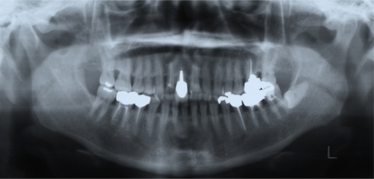 Figure 3 Left horizontal incompletely impacted third molar without lamina dura below the crown in a 53-year-old woman.
