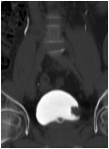 Figure 7 Bladder tumor. Computed tomography urography shows soft tissue tumor at the left bladder wall.