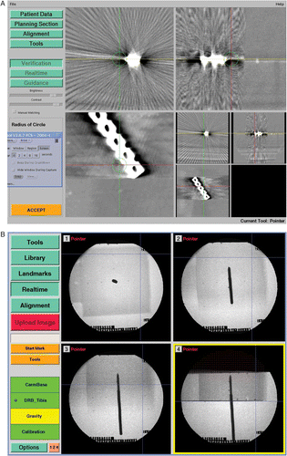 Figure 3. A) Screenshot showing artifacts seen with a 5-hole plate: in this case, the extremely heavy artifacts impair localization of the PVC markers. B) Screenshot of the fluoroscopy-based experimental setup: the PVC markers can be seen easily. The stainless steel Schanz screw does not influence the registration. [Color version available online.]