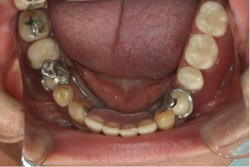 Figure 17 Mandibular denture in situ (flipped mirror image).