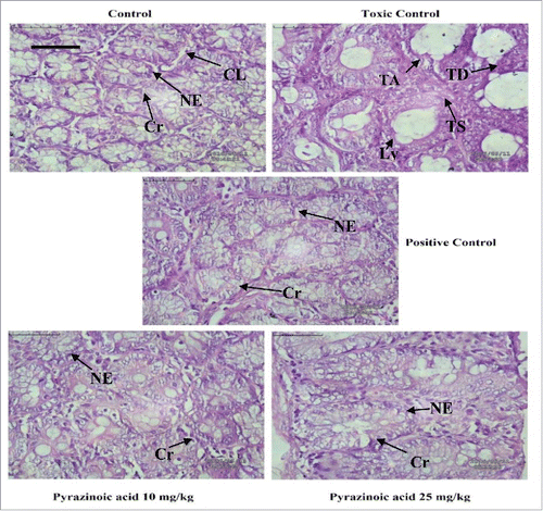 Figure 4. The colonic pathological changes in DMH-induced CC rats (Scale bar 50 µm). Tumoral vacuoles were prominent in DMH group which was absent after 5-FU and PA administration. (Cr- Crypts, NE- Normal epithelium, CL− Colon lumen, TA- Tubular adenoma, TD- Tumoral deposits, Ly- Lymphatics (lined by endothelium), TS- Tumor stroma).
