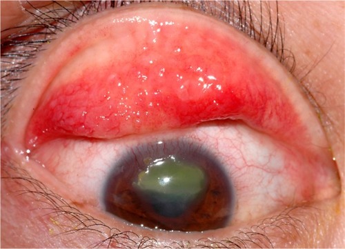 Figure 1 Ten-year-old boy with vernal keratoconjunctivitis demonstrating superior palpebral conjunctiva with giant papillae within an intensely inflamed conjunctiva and shield ulcer in the cornea with fluorescein staining. (Courtesy of Todd P. Margolis, MD, PhD).