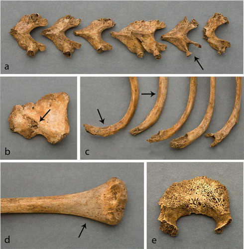 Figure 3. Lesions characteristic of tuberculosis in SK 1155, an 8.5–10.5-year-old child, from Medieval Ballyhanna, Co. Donegal, Ireland. (a) Bone destruction and pitting on the neural arches of T2–8, with particularly pronounced lytic activity on T3. Note that T4 and T5 had formed a partial block vertebra which is a developmental defect. (b) Lytic activity and pitting on the auricular surface of the left ilium. (c) Periosteal new bone formation and lytic activity on fragments of right ribs. Note the destruction of the heads in three of the ribs. (d) Periosteal new bone formation on the anterior surface of the distal right humerus. (e) Extensive bone destruction of the inferior body surface of L5 (photographs by Jonathan Hession).