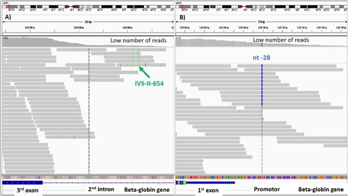 Figure 4. Whole exome sequencing showing the number of reads covered on IVS-II-654 and nt-28 mutations. The number of reads was too low. Therefore, the mutations could not be confidently called by whole exome sequencing. (A) The IVS-II-654 mutation was located in the second intron. (B) The nt-28 mutation was located in the promoter. Both mutations were confirmed by PCR.