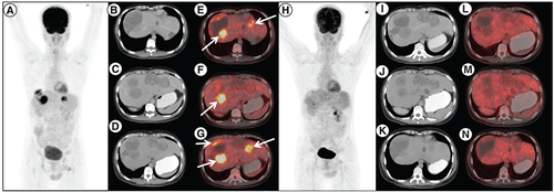Figure 1. Response to imatinib, sunitinib and regorafenib therapy in case 1. 18F-Fluorodeoxyglucose (FDG) positron emission tomography/computed tomography (PET/CT) done post imatinib, sunitinib and regorafenib therapy in patient A. (A) maximum intensity projection, (B, C & D) axial contrast enhanced CT and (E, F & G) fused PET/CT images showing multiple solid cystic masses with increased FDG uptake in the enhancing solid component (arrows) suggestive of metabolically active liver metastases. Follow-up 18F-FDG PET/CT done 3 months after initiation of avapritinib therapy, which revealed resolution of metabolic activity in the corresponding lesions (H–N) with hypodense/cystic changes in the previously enhancing lesions, suggestive of complete metabolic response.